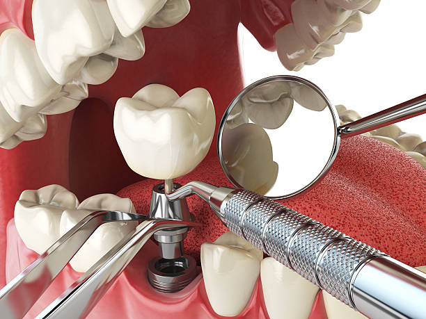 Best Broken or Cracked Tooth Emergency Dentist in Montgomery, IL